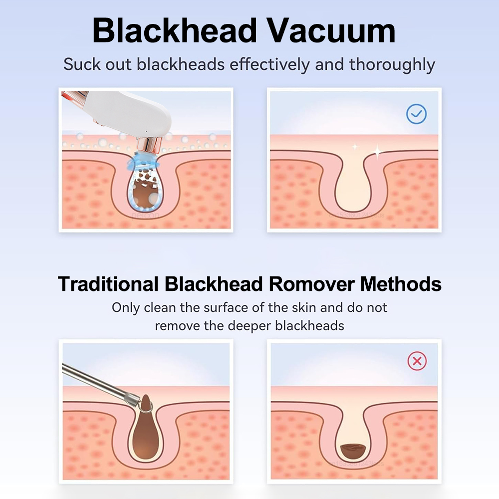 Electric Blackhead Remover Vac - Blackhead Remover Vacuum Suction 评论和价格