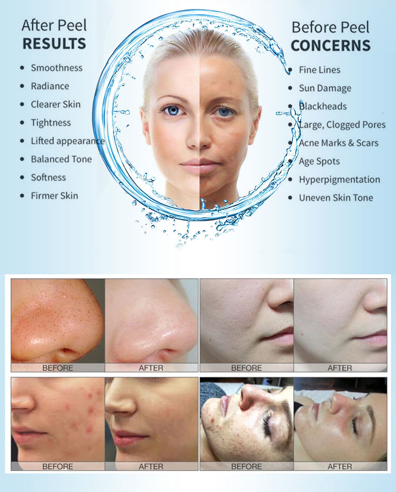 Hydra 4 In 1 Aqua Peeling Skin - Hydra Dermabrasion Aqua Peel Machine 评论和价格