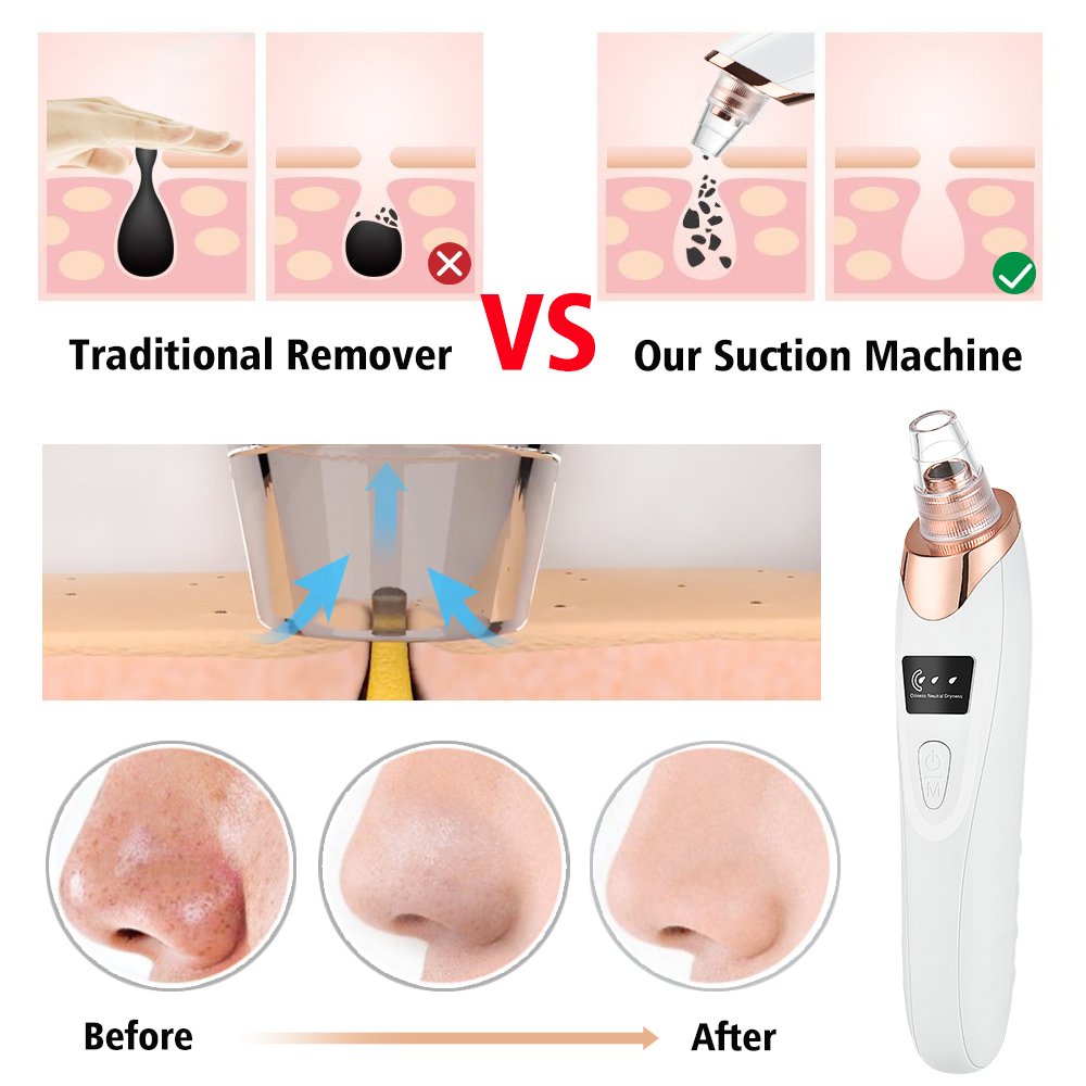 Blackhead Remover Vacuum Pore  - Blackhead Remover Vacuum Suction 评论和价格