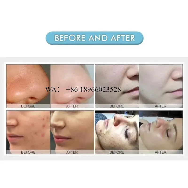 WMWMNU for Desktop Blackhead R - Blackhead Remover Vacuum Suction 评论和价格